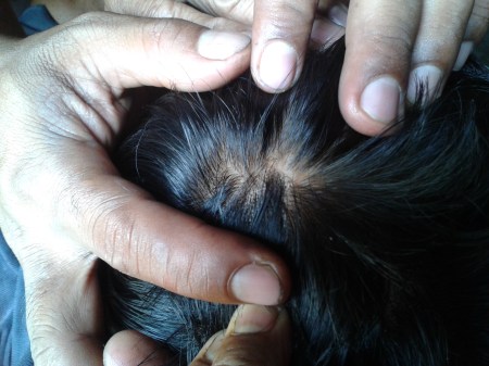 কথার ফাকে হেমরঞ্জন মাথায় আঘাতের চিহ্ন মেলে ধরেন, হিংস্র ইতিহাসের সাক্ষী এই দাগ 